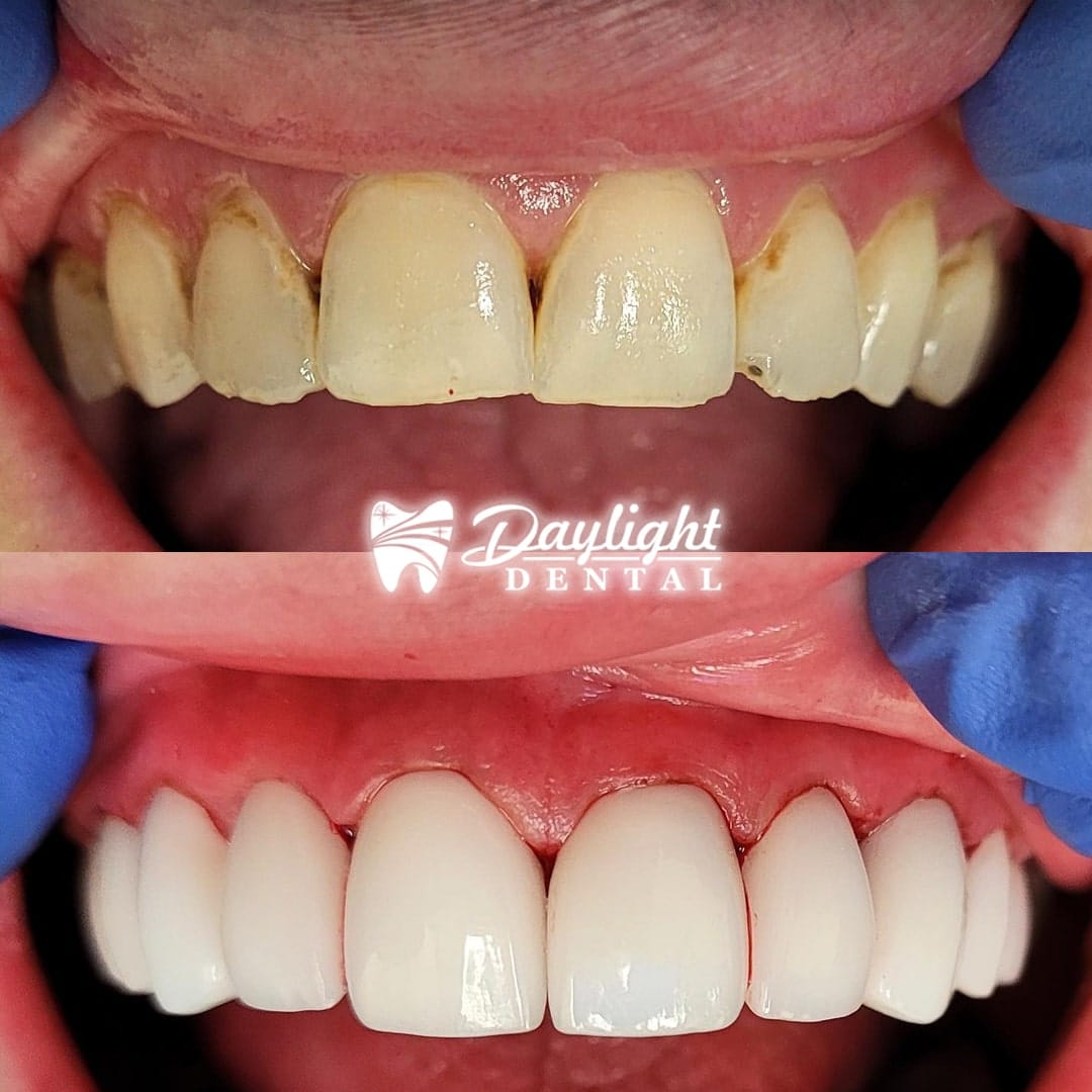 Before After Gallery-Dentist in Austin