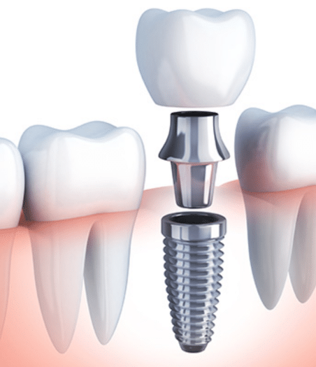 dental implants south austin
